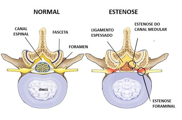 Corte transversal de uma vértebra lombar em duas situações lado a lado. À esquerda, o canal espinal normal, com a faceta articular, o forame e o disco identificados. À direita, o mesmo nível com estenose: o ligamento espessado e as articulações aumentadas reduzem o espaço do canal medular e do forame.