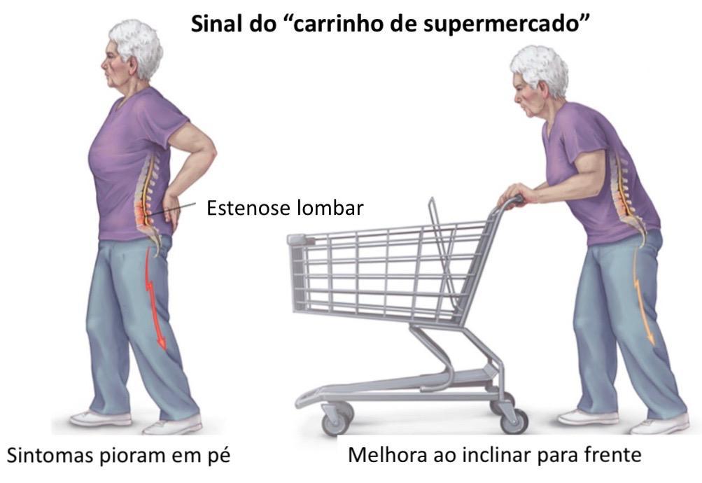 Ilustração chamada sinal do carrinho de supermercado. À esquerda, uma senhora em pé, com a coluna lombar destacada e uma seta descendo pela perna: os sintomas pioram nessa posição. À direita, a mesma senhora inclinada para a frente empurrando um carrinho de supermercado, com a coluna aliviada.